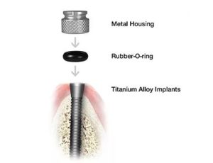 a mini implant and a 3 part cut away with a metal housing rubber o ring and a titanium alloy implant