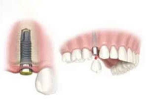 a single implant with a tooth on it