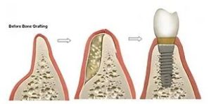 a bone grafting diagram showing how it can restore your bone to receive dental implants