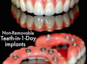 teeth in a day full arch of implants