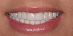 tracey a patient at durham implant solutions with a full arch of teeth after receiving dental implants