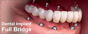 all on 6 dental implants illustration showing the screws and implants and the full bridge across it