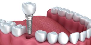 a dental implant with a tooth on top thats about to be placed into the jaw