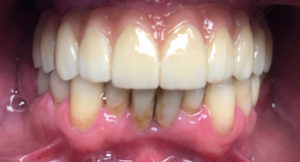 2 full arch upper after Durham Dental Solutions