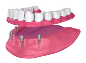 4 denture implants with a full arch of teeth over them