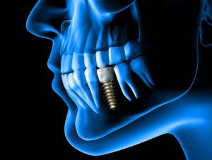 dental implant shown with an x-ray through the jaw of a man