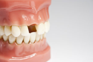 a missing tooth on a jaw model