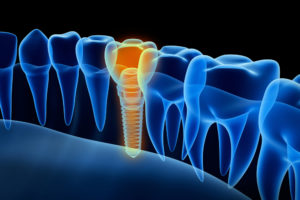 a diagram of pain in the dental implant by highlighting it red in contrast to the blue of the rest