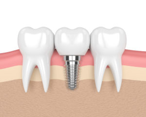 a single implant with 2 teeth being shown around it