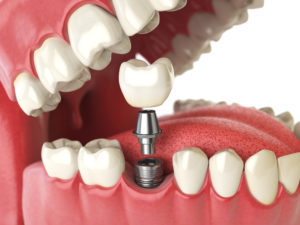 a layered dental implant with cutaways