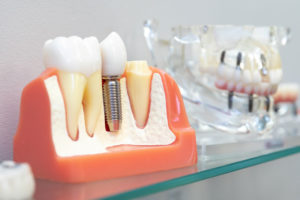 a model of a single dental implant placed next to the molar and the difference with the crown