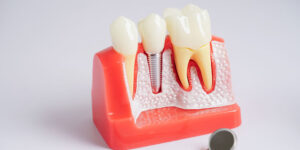 a dental implant model with a cut away showing the bone and teeth around it