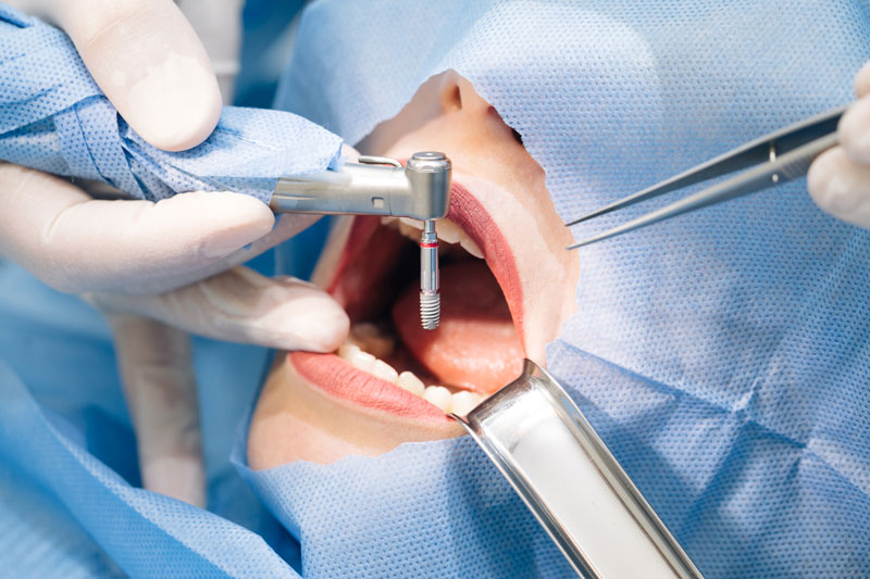 a sedation patient receiving dental implants