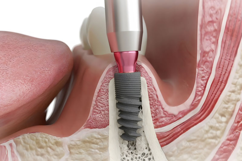 Dental-Implant-Jaw-Cutaway